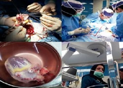 انجام پیوند موفقیت آمیز قلب بر روی کودک 6 ساله