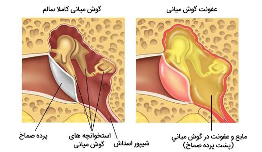 همه چیز درباره عفونت گوش