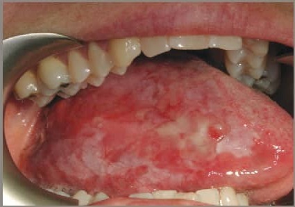از سرطان حفره دهان و زبان چه می&zwnj;دانید؟