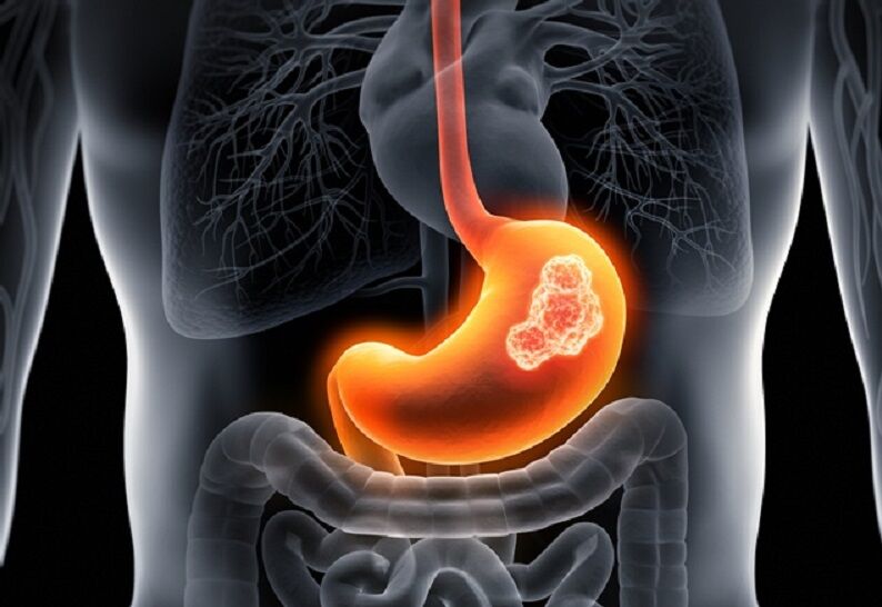 افزایش دوبرابری ابتلا به سرطان گوارش در افراد جوان