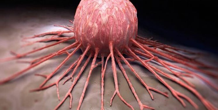 تجزیه و تحلیل ماموگرافی با کمک هوش مصنوعی