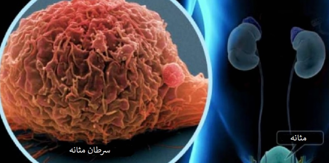 تصویربرداری دقیق‌تر از تومور سرطانی مثانه با نانوفناوری