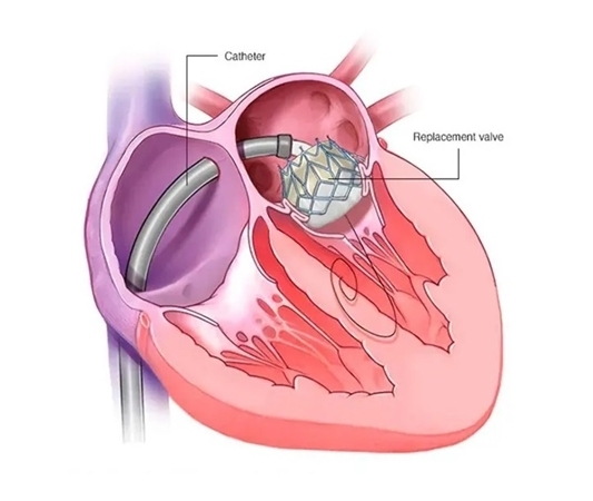 تعویض دریچه قلب بانوی ۸۳ ساله بدون عمل جراحی باز در همدان تعویض دریچه قلب بانوی ۸۳ ساله بدون عمل جراحی باز در همدان