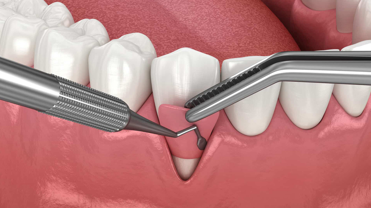 فناوری نانو، راهکاری برای تسریع ترمیم و کاهش خطر عفونت جراحی دندان فناوری نانو، راهکاری برای تسریع ترمیم و کاهش خطر عفونت جراحی دندان