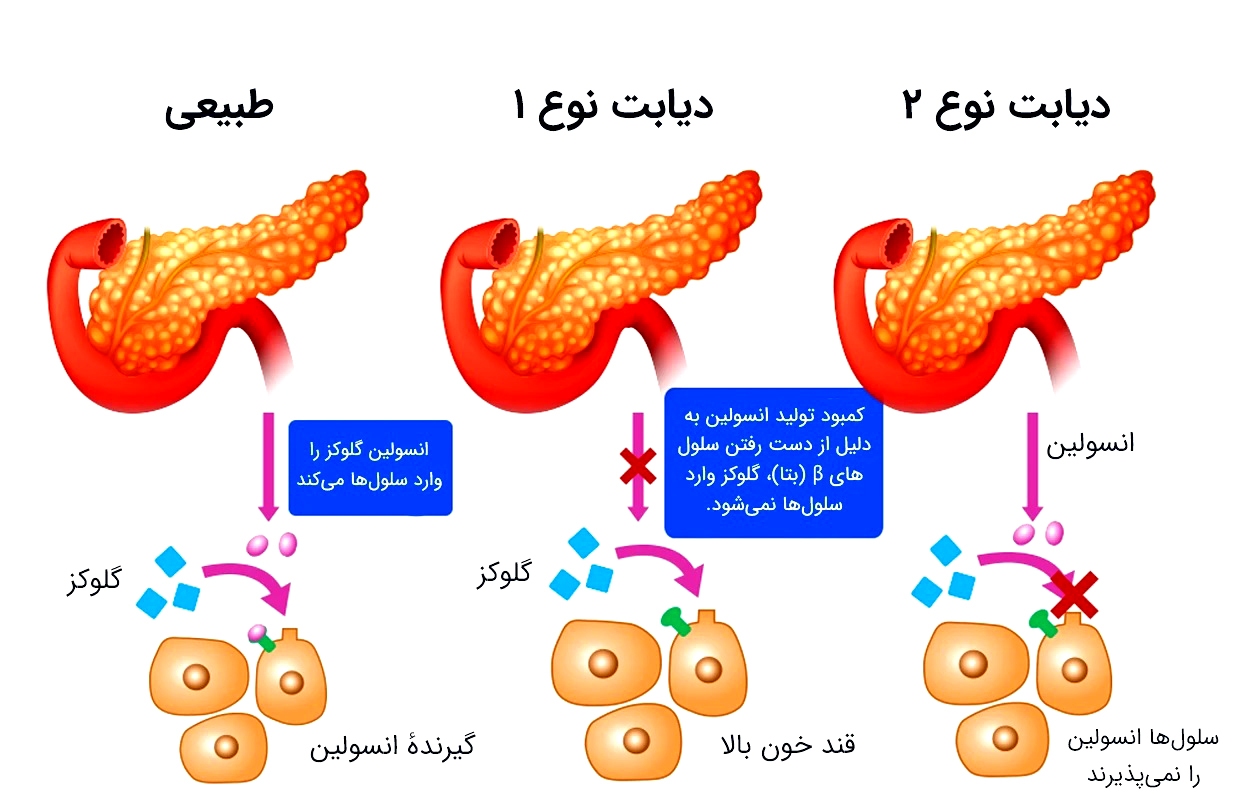 ابتلا به دیابت نوع ۲ در افراد کمتر از ۲۰ سال
